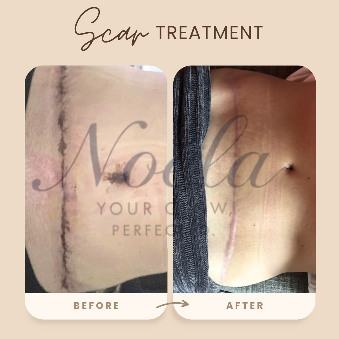 Red Light Therapy Wrap